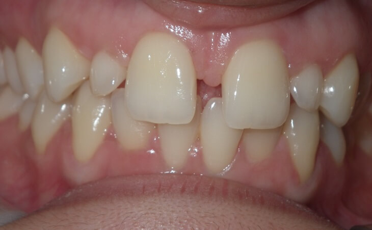 Congenitally Missing Lateral Teeth Treatment Before
