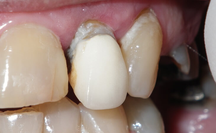 Single Tooth Replacement Before