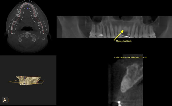 Missing Front Tooth Replacement Before