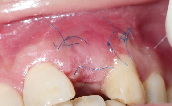 Bone Defect & Missing Tooth Treatment Before