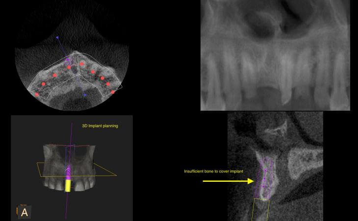 Single Tooth Replacement Before