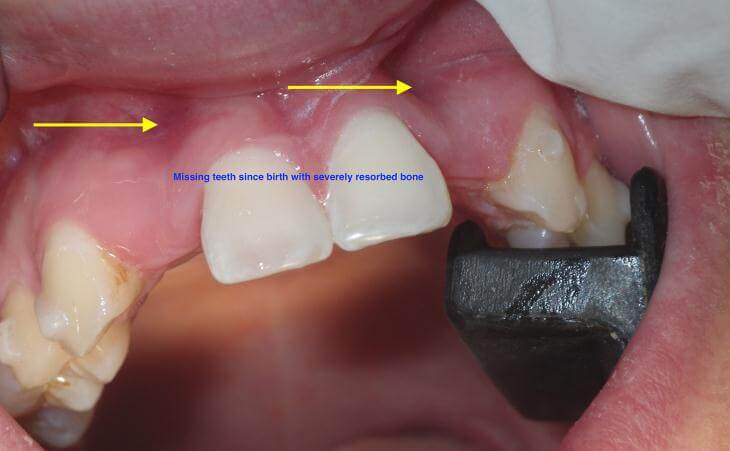 Bone Graft For Missing Teeth Before