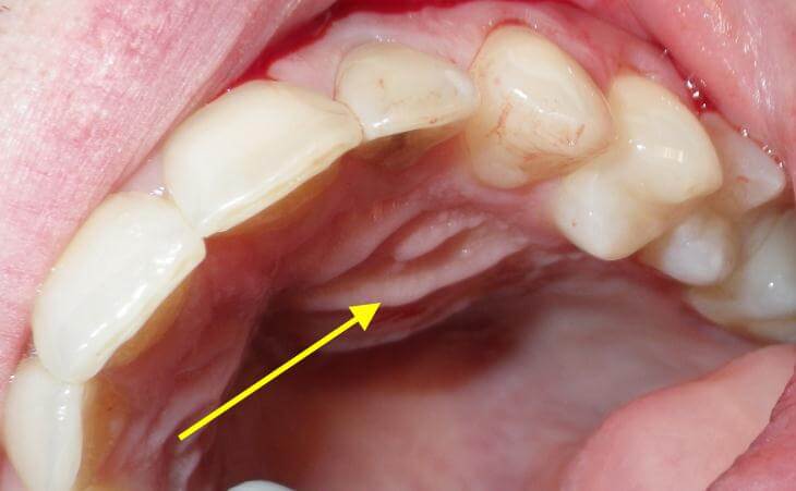 Bone Regeneration And Cyst Removal Before