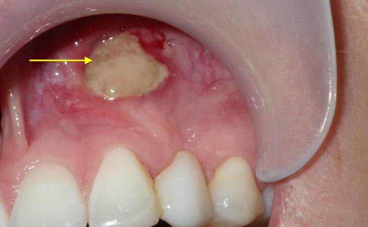 Before - impacted canine and exposed bone 