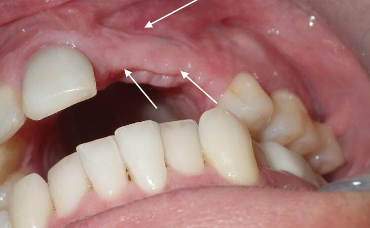 Bone Replacement And Dental Implants Before