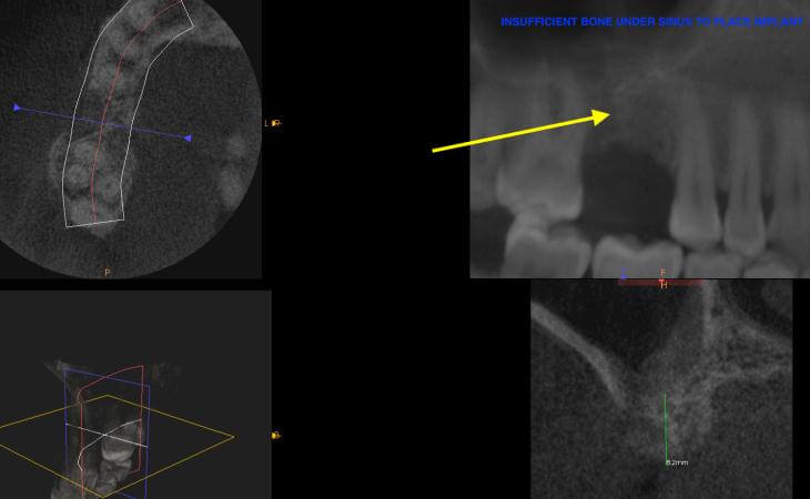 Internal Sinus Lift Before