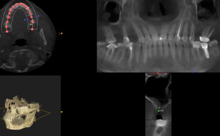 Bilateral Sinus Lift Surgery Before