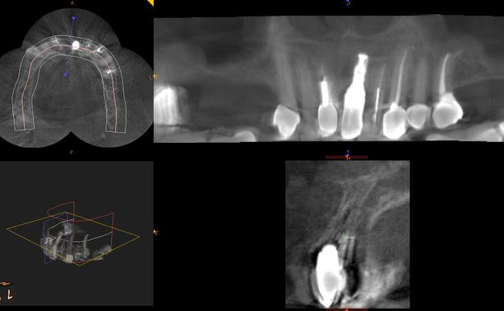 Pre Bilateral Sinus Lift Surgery