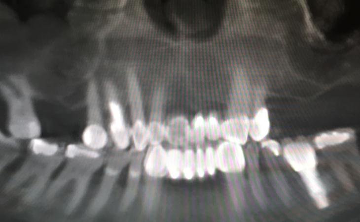 Bilateral Sinus Lift Treatment Before