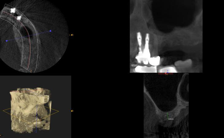 Left Upper Jaw Sinus Lift Before