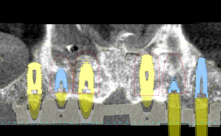 Implant Planning Using Virtual Surgery