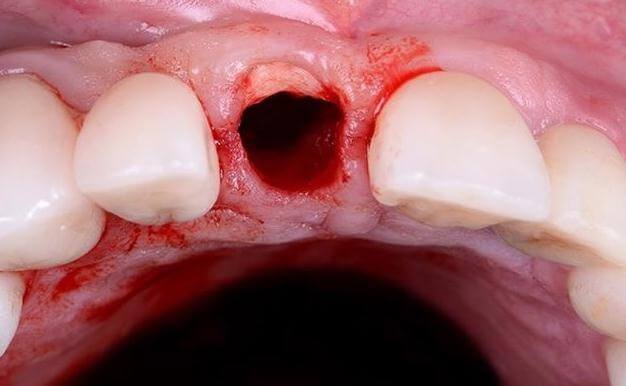 Replacing Single Tooth Before