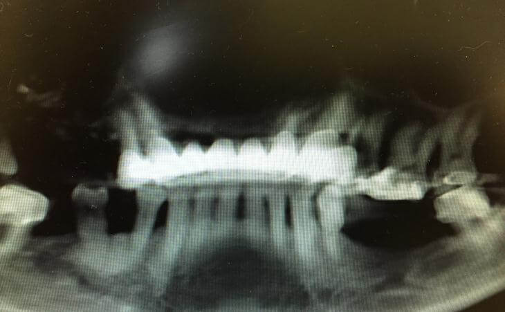 Bone Grafting For Tooth Replacement Before