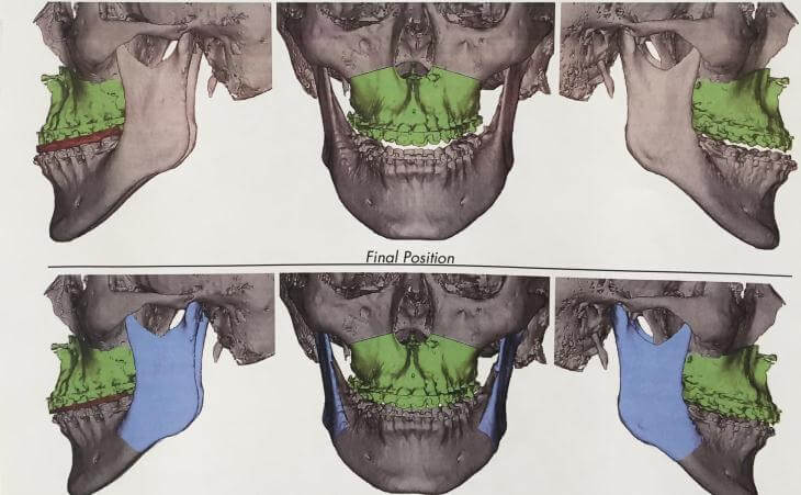 Surgical Virtual Planning