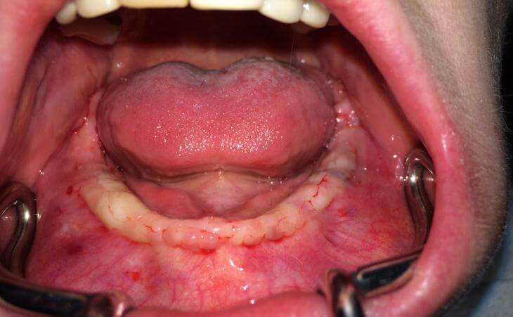 4 Implant OverDenture Before