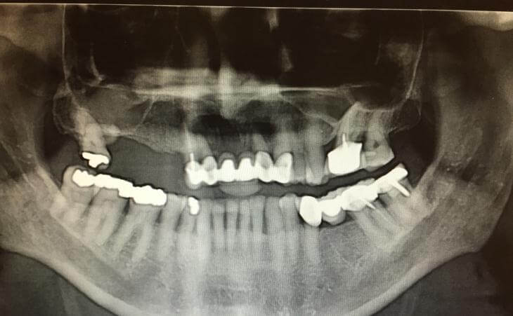 Guided Implant Surgery Tooth Replacement Before