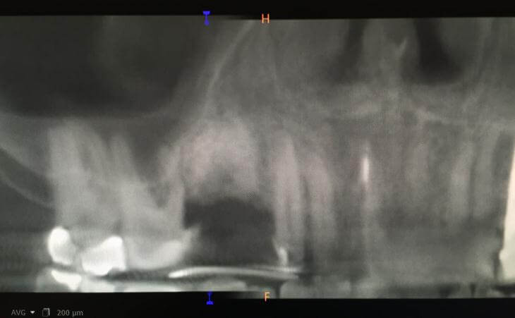 Guided Implant Placement Before