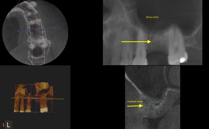 Missing Molar Tooth Replacement Before