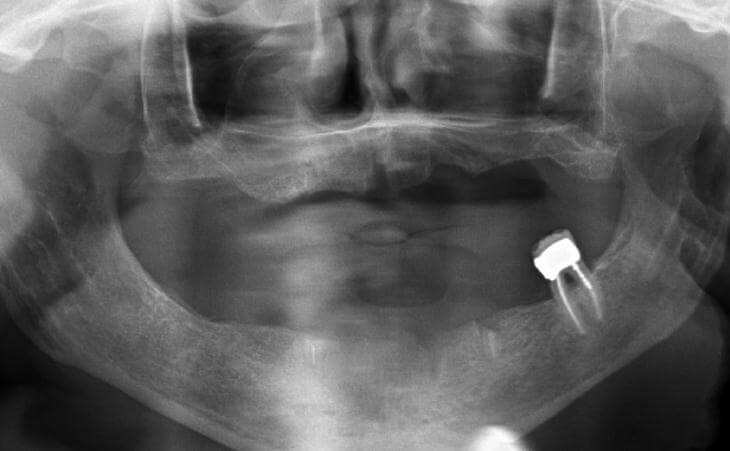 Implant-Supported Denture Before