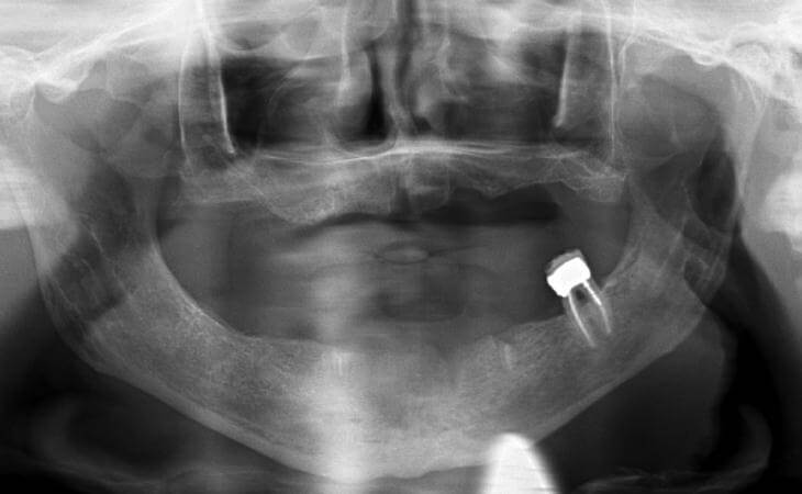 Dental Implants For Dentures Before