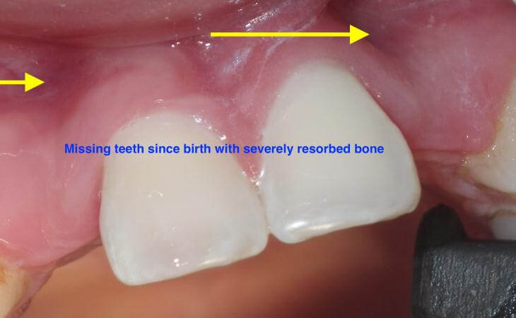 Missing Lateral Teeth Replacement Before