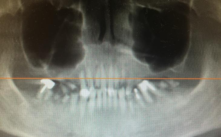 Before - failing dentition