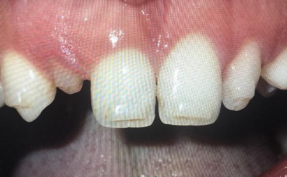 Replacing Baby Teeth With Immediate Implants Before