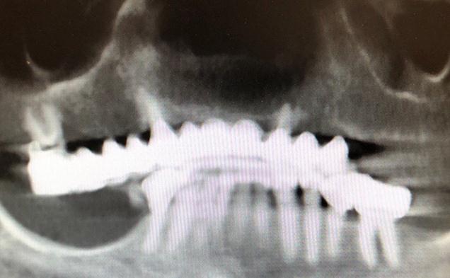 Guided Implant Surgery Of Upper And Lower Jaw Before