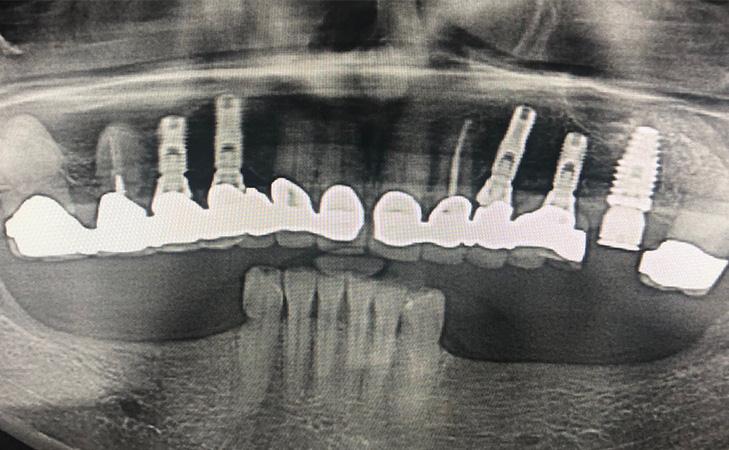 Replacing Multiple Teeth Before