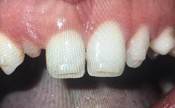 Replacing Baby Teeth With Immediate Implants Before
