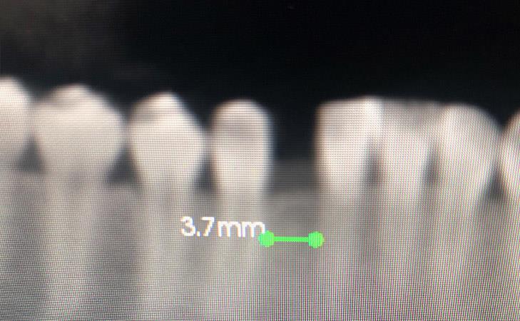 Replacing Single Tooth With Guided Implant Surgery Before