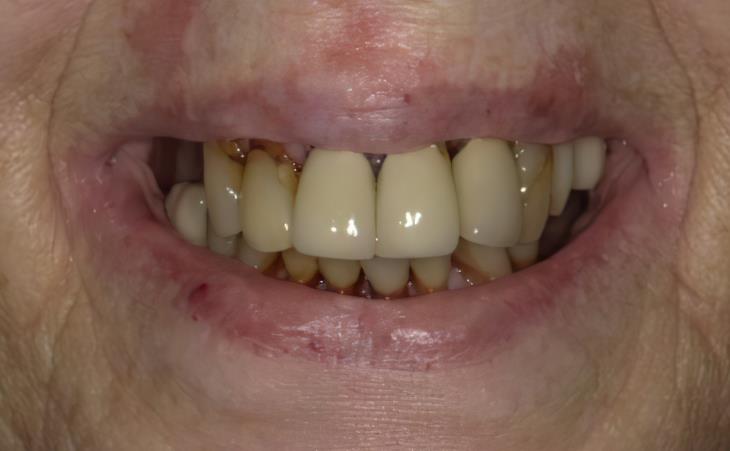 Before All-on-6 Dental Implants 