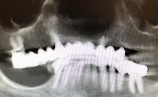 All-on-X Dental Implants X-Ray