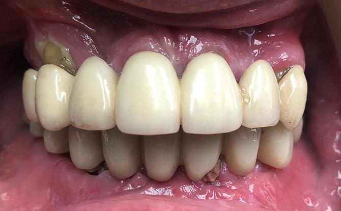 All-on-X Placement of Temporary Teeth