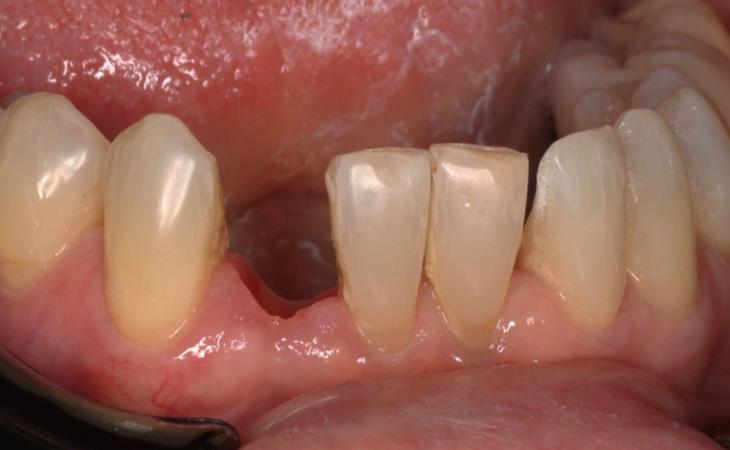 Missing Tooth Before Dental Implant 