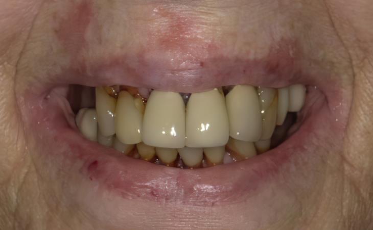 Before Immediate Dental Implants