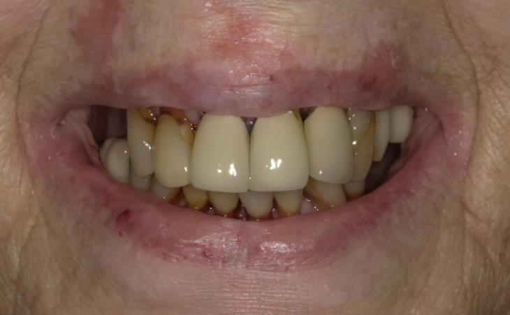 Immediate Dental Implants Before
