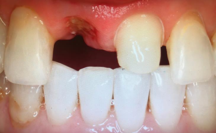 Before - Broken Front Tooth