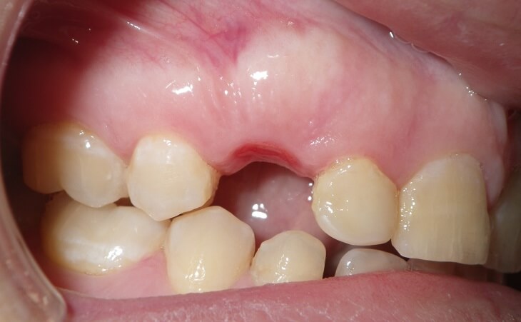 Bone Graft For Tooth Replacement