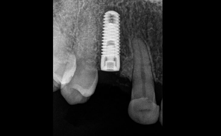 Post Implant Placement