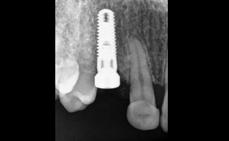 Dental Implant Post-op Exposure 