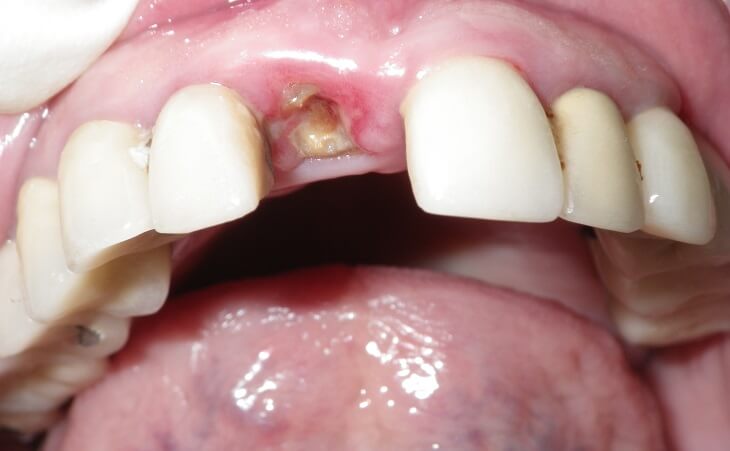 Broken Front Tooth Extraction