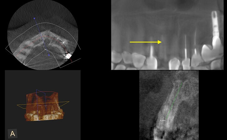 CT Scan Of Broken Front Tooth