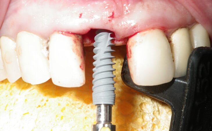 Dental Implant For Broken Front Tooth