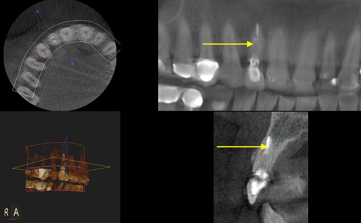 CT Scan Before Tooth Removal