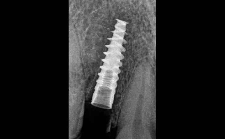 Placement Of Immediate Dental Implant