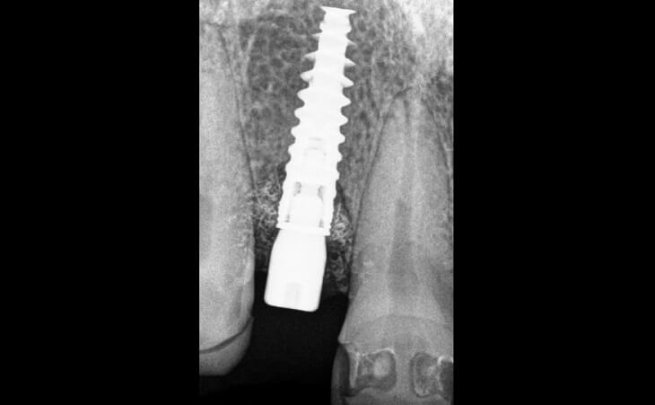 Post-op Exposure Of Dental Implant