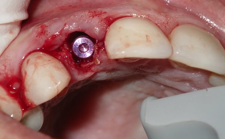 Immediate Dental Implant Placement