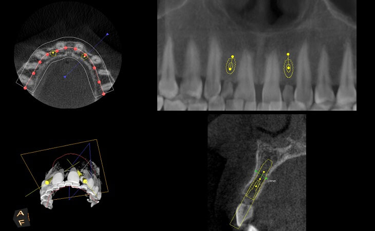 Virtual Dental Implant Planning