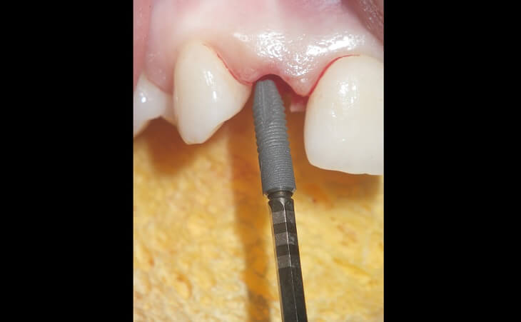 Dental Implant Being Placed